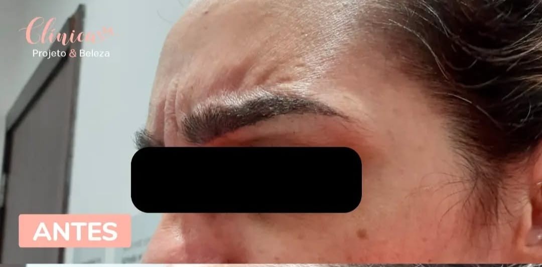 Antes da aplicação de Botox