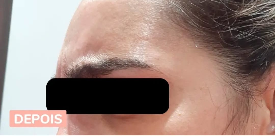 Depois da aplicação de Botox