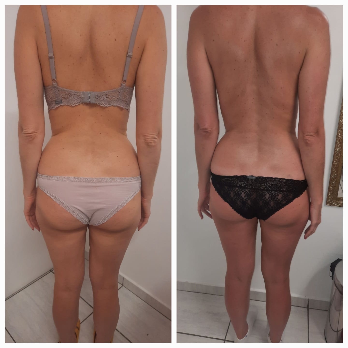 Antes e depois de drenagem linfática manual