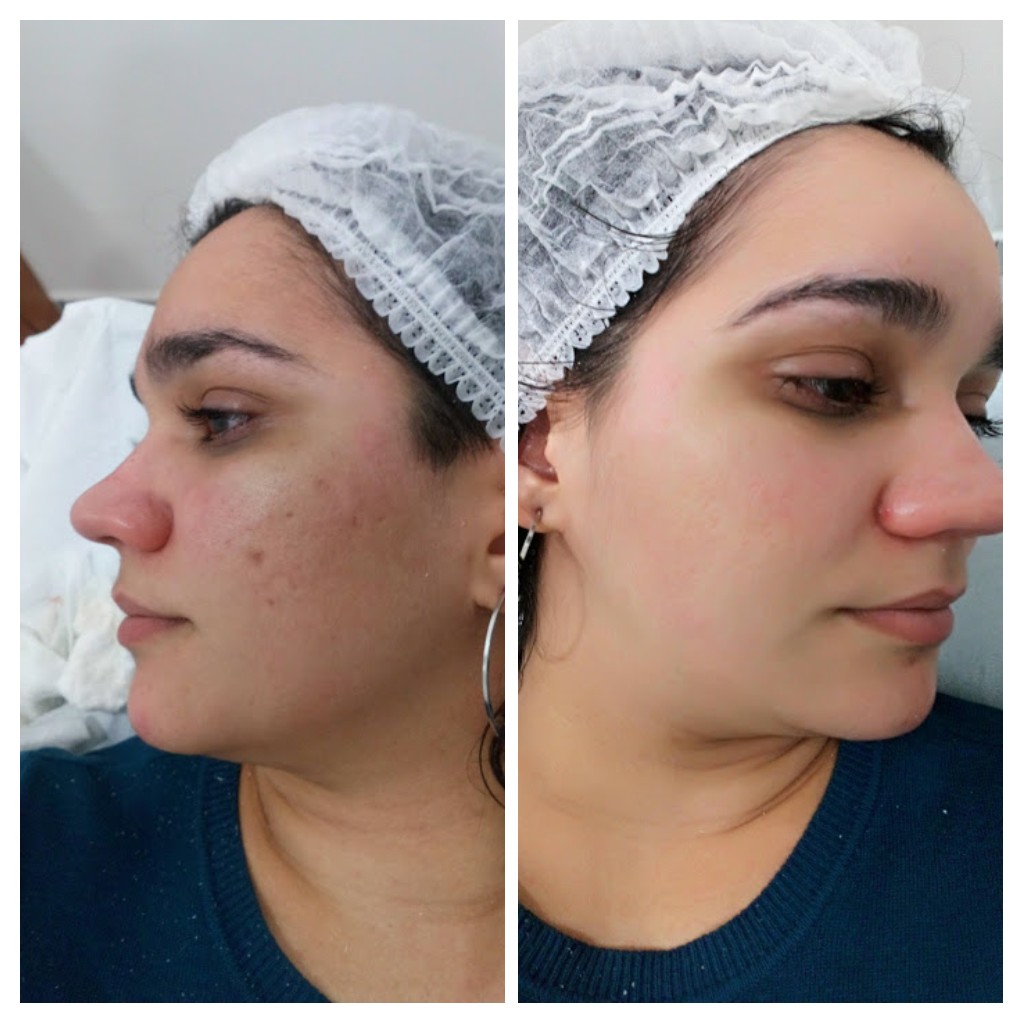 Antes e depois de limpeza de pele profunda