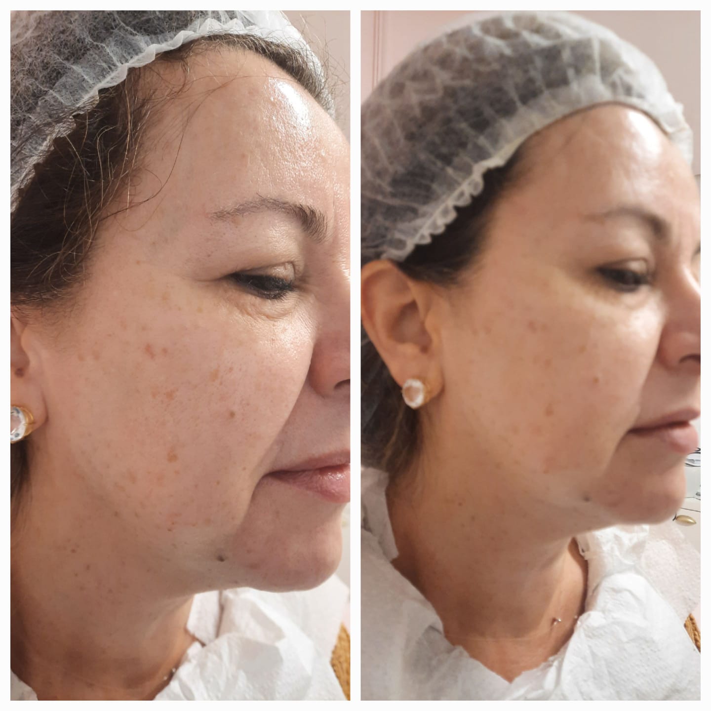 Antes e depois de peeling facial