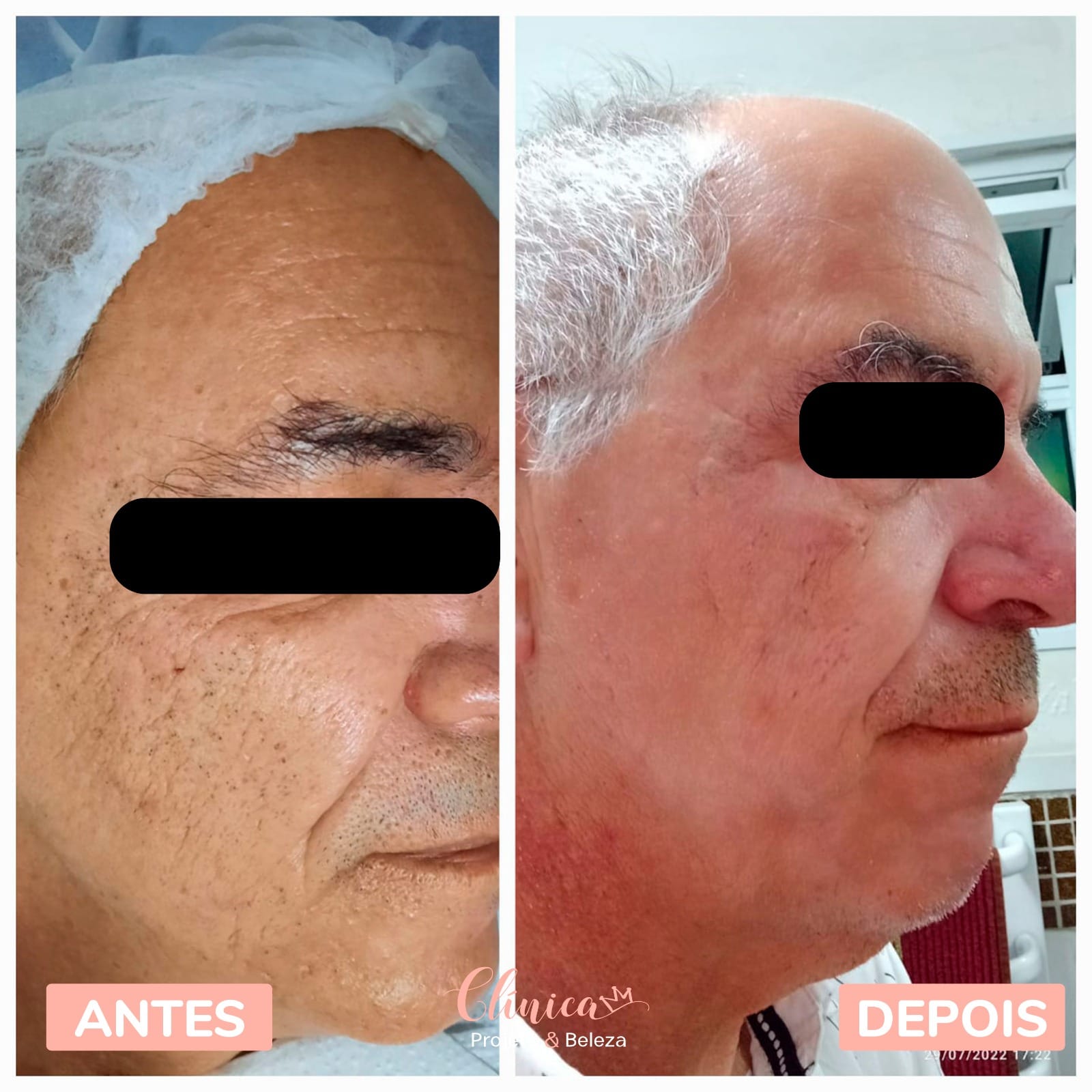 Antes e depois de Rejuvderm